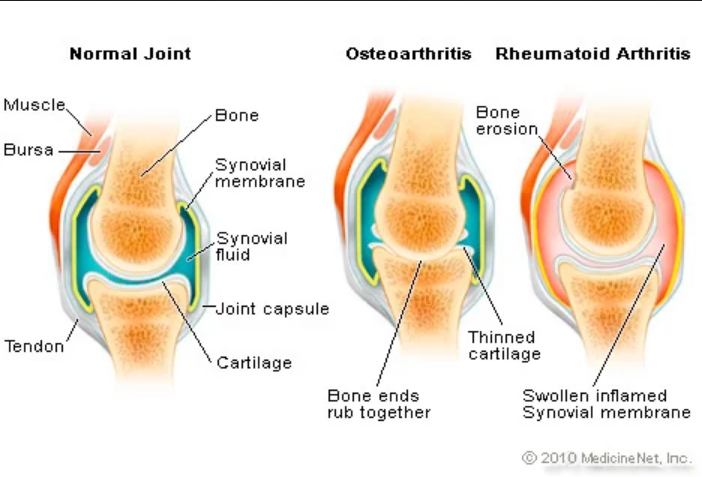 How to Treat Arthritis with Norland Products in Nigeria