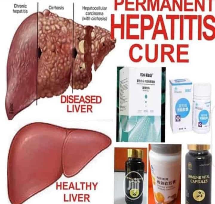 How to treat Hepatitis (Inflammation of the Liver) with Norland Products in Nigeria