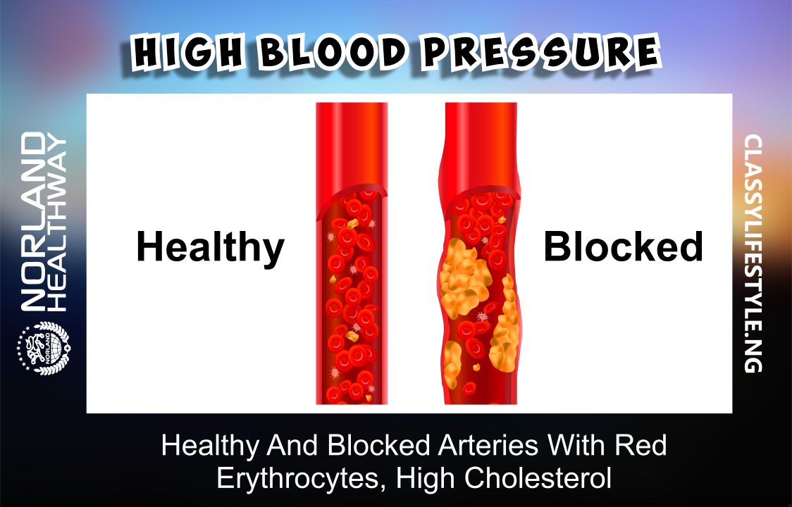 How to treat Hyper-Tension (High Blood Pressure) with Norland Products in Nigeria