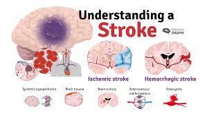 How to treat stroke with Norland Products in Nigeria