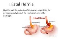 How to Treat Hiatus Hernia with Norland Products in Nigeria