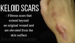 How to Treat Keloids with Norland Products in Nigeria