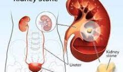 How to Treat Kidney Stone with Norland Products in Nigeria