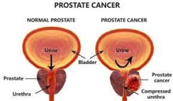 How to Treat Prostate with Norland Products in Nigeria
