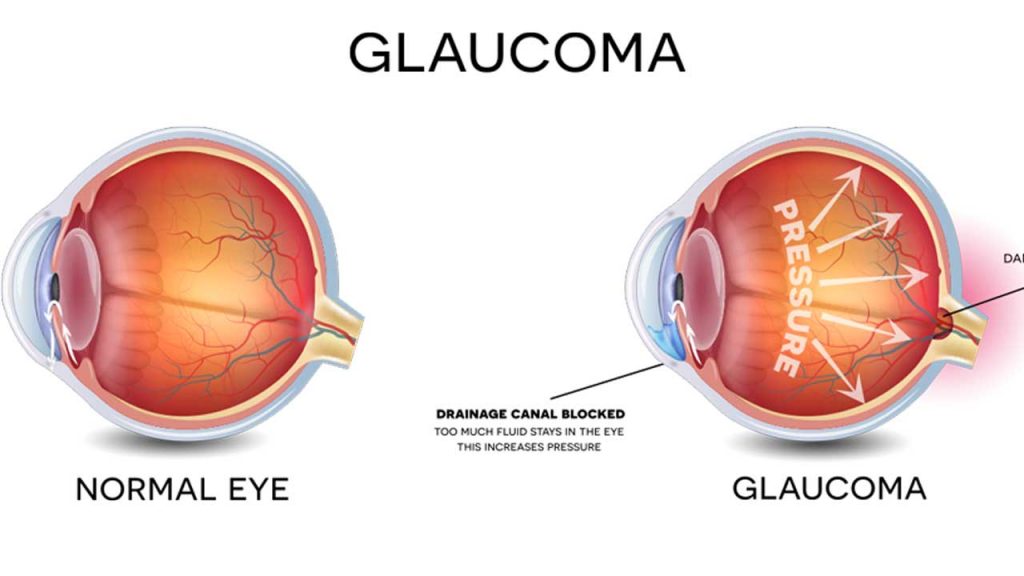 Herbal Solution to Eye Problems including GLAUCOMA, CATARACT and MYOPIA